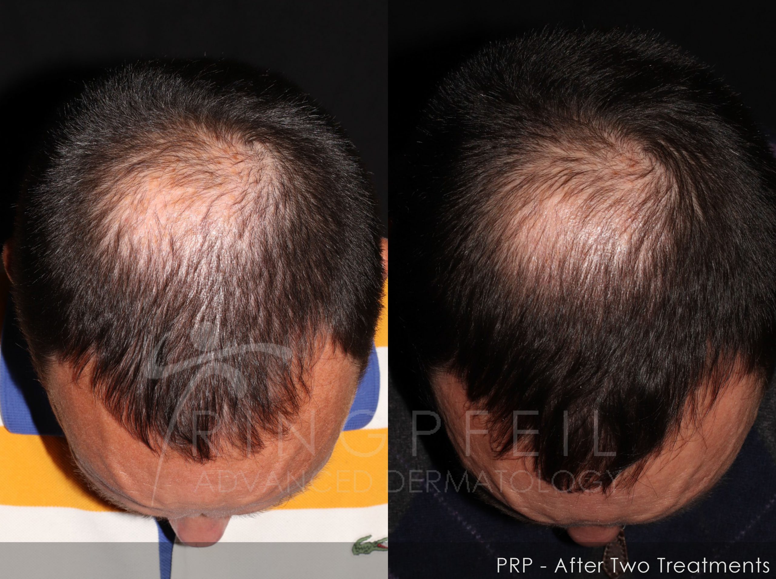 PRP after two treatments